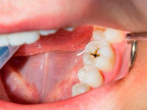 Caries Dental