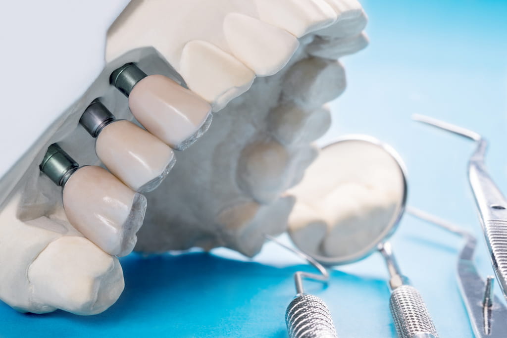 dentadura postiza o implantes