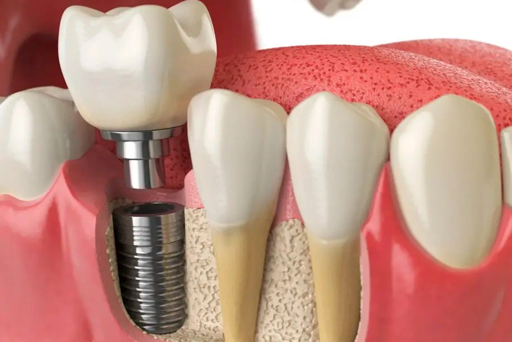 Implantes dentales en Córdoba