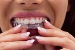 que es un retenedor dental