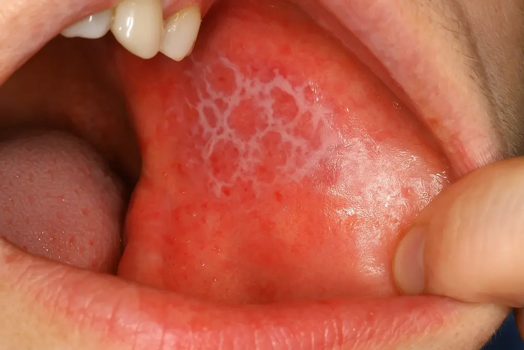 Liquen plano en la lengua