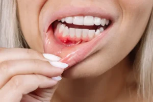 mejor pasta de dientes para el sangrado de encías