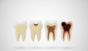 Tipos de caries
