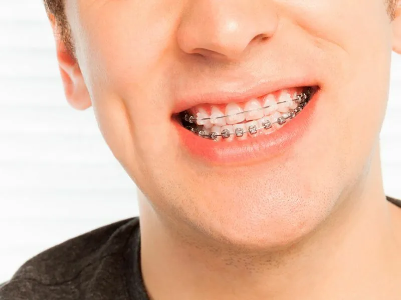 Mitos y verdades sobre la ortodoncia