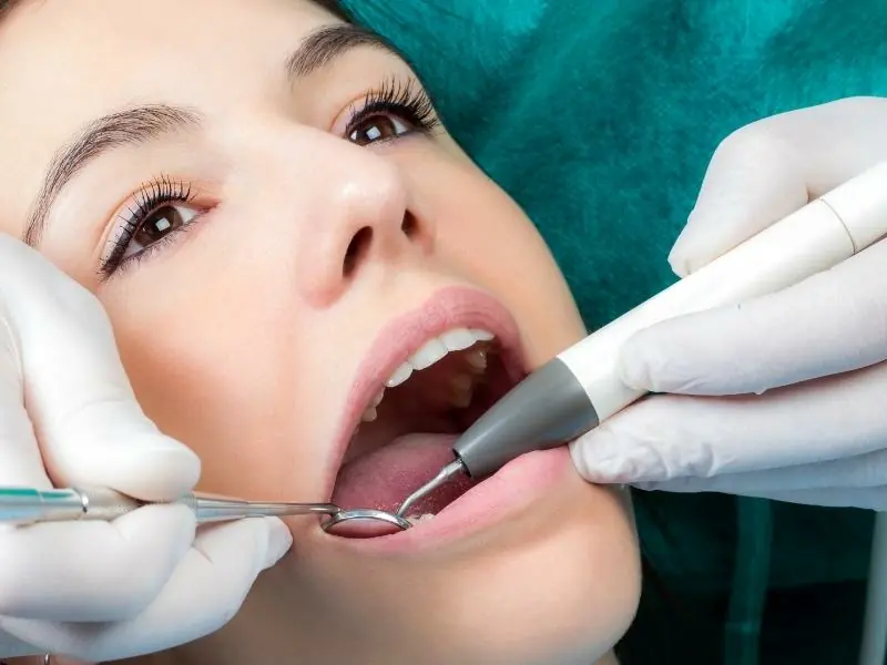 ¿Qué es un sellado de dientes