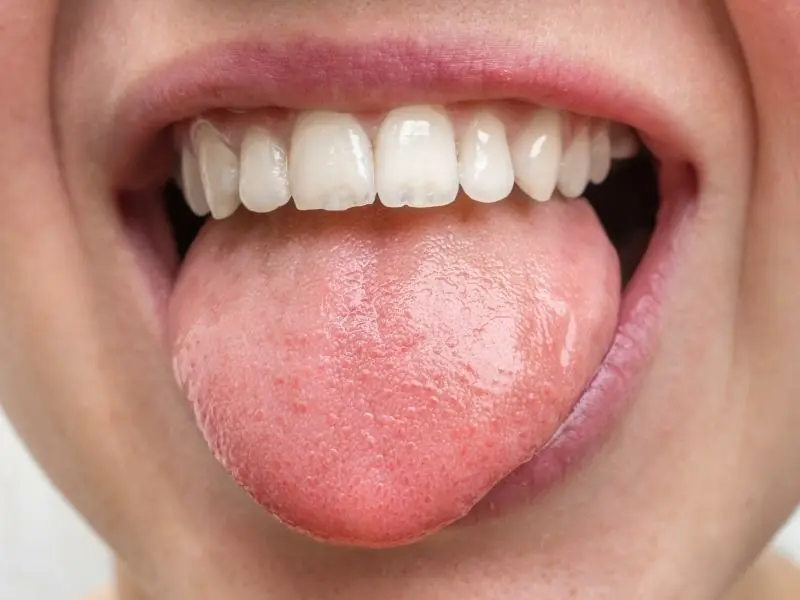 Enfermedades más comunes de la lengua